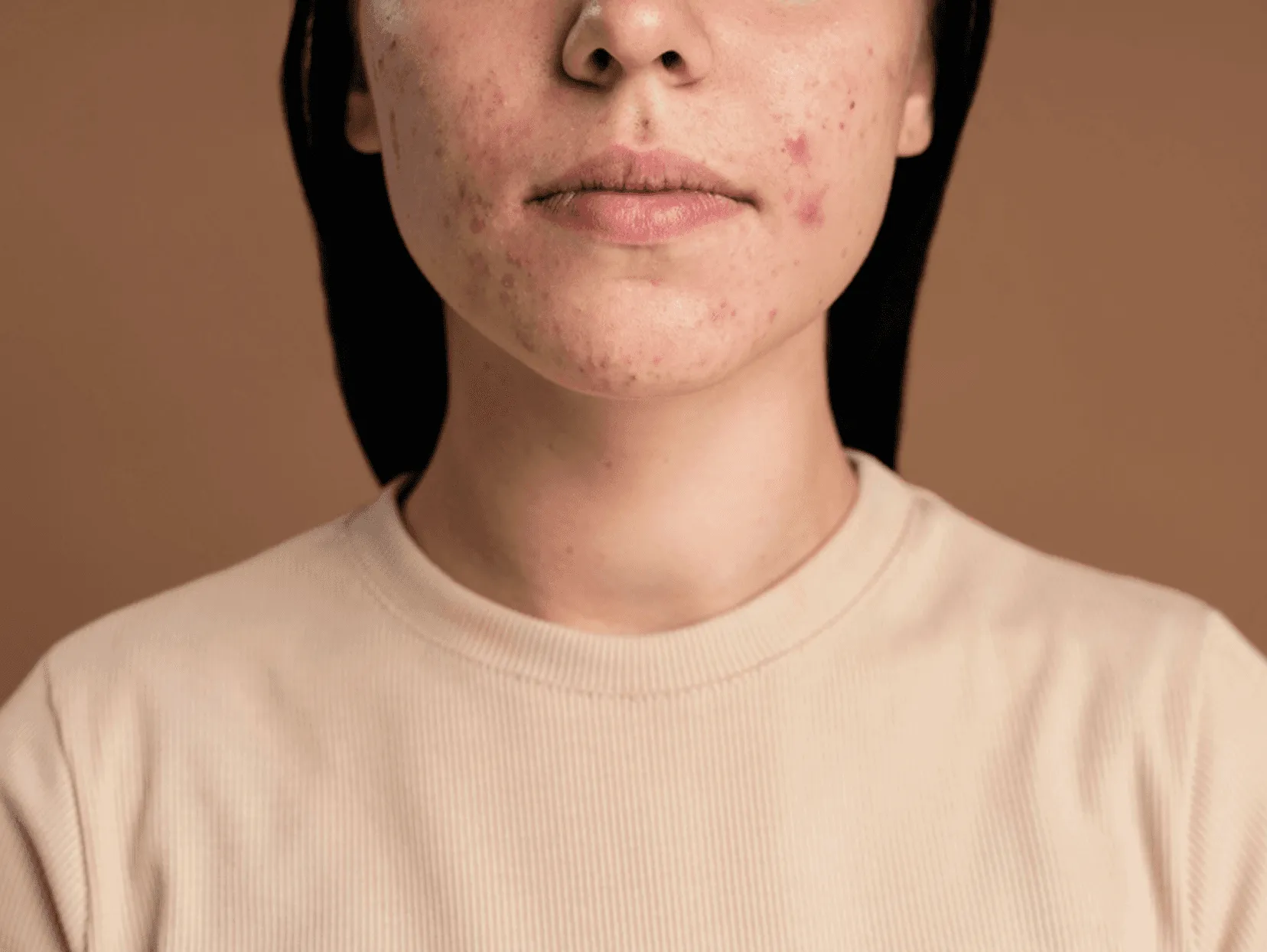 Acne Treatment in Calicut: Causes, Care & Clinical Solutions