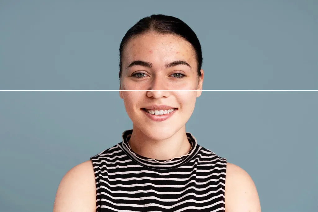 Acne & Scar Treatment
