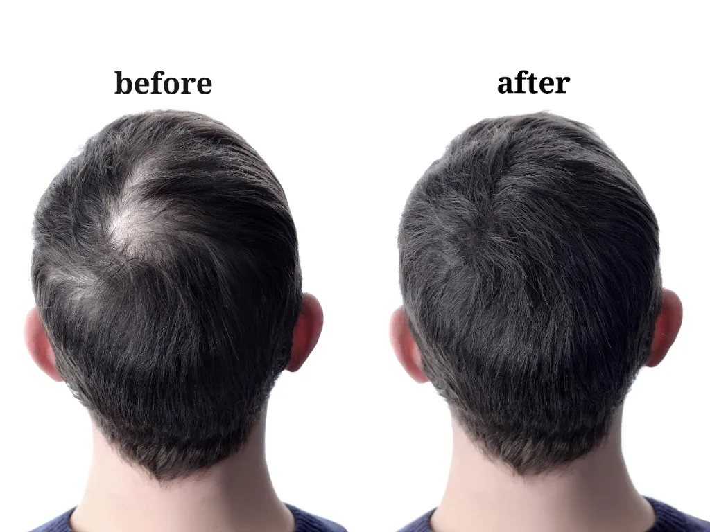 Hair Loss & Hair Regrowth