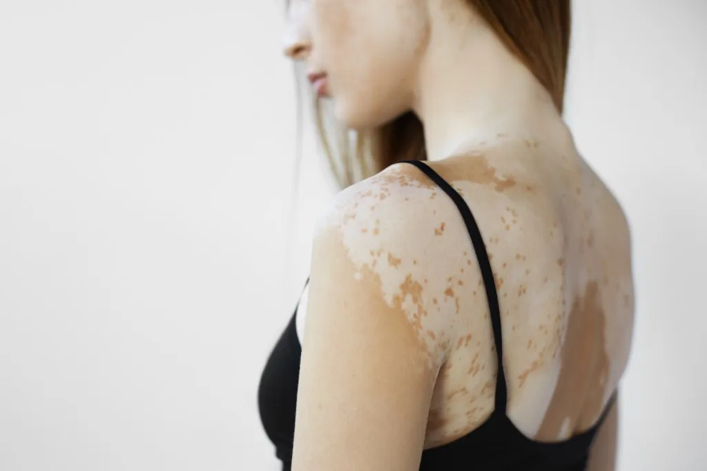Vitiligo Surgery