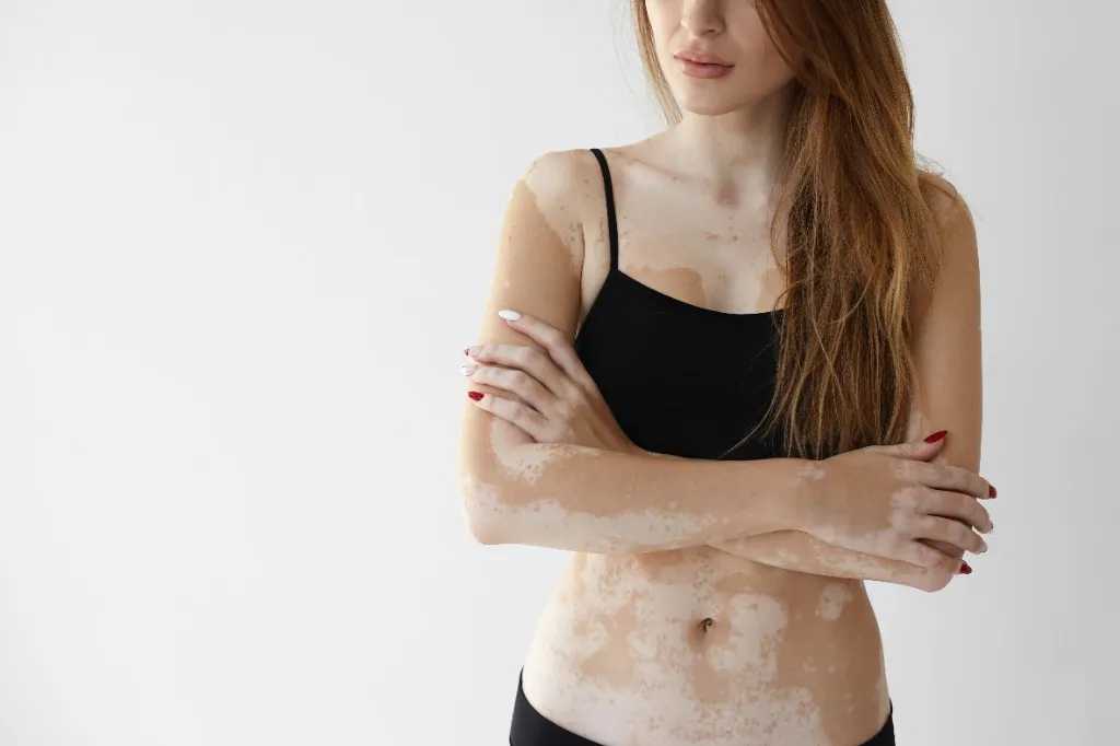 Vitiligo Camouflage
